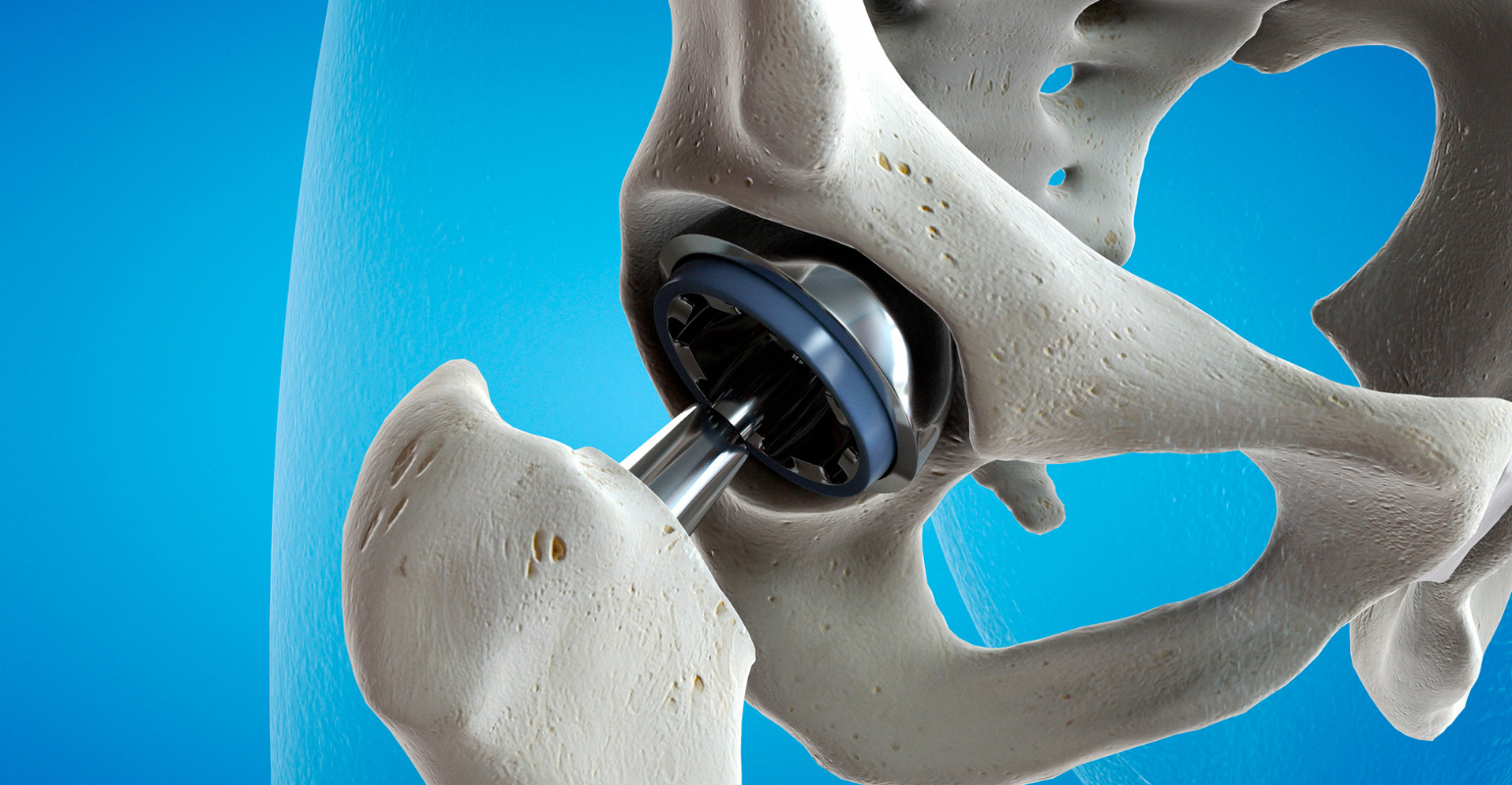 Orthopedic implants play a vital part in contemporary medicine | Omnia ...