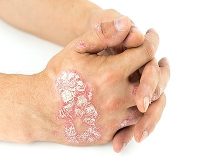 Experts Emphasise Early Psoriasis Treatment | Omnia Health Insights